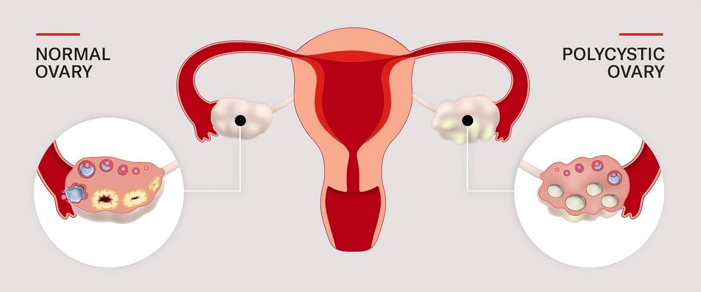 PCOS and PCOD treatment services in Bharuch
